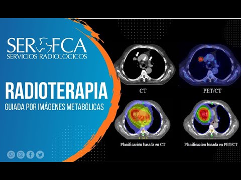 Vídeo: Imagen De Haz De Iones De Helio Para Radioterapia Iónica Guiada Por Imágenes