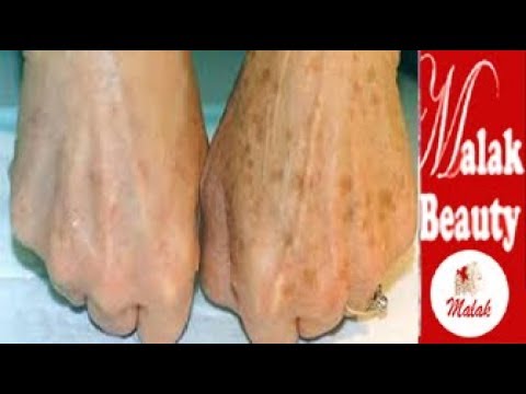 الإعجاز في هذا المكون للقضاء نهائيا على البقع البنية باليدين واى منطقة فى الجسم مع خبيرة التجميل ملك