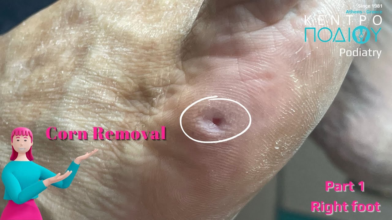 Corn removalΑφαίρεση τύλωνΚέντρο Ποδιού PodiatyPodiatristΠοδιατρική