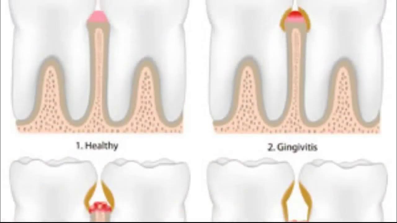 Nature's Smile Gum balm Advanced Solution To Prevent Periodontal