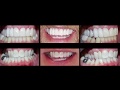 Invisalign and dental crowns before and after images at cosmetic dental associates san antonio tx