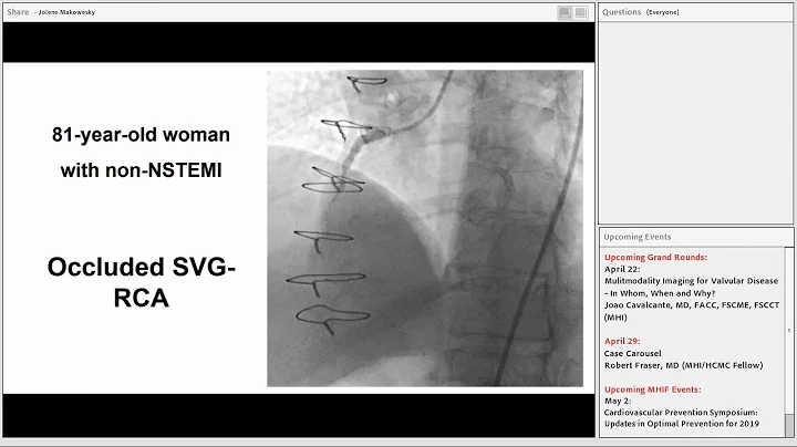 Emmanouil Brilakis - Update on Chronic Total Occlusion (CTO) Percutaneous Coronary Intervention