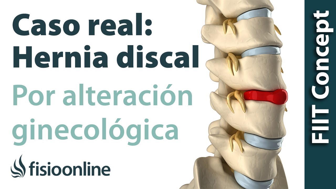 Hernia discal lumbar por una alteración ginecológica Caso clínico