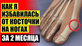ДЕФОРМАЦИЯ ПЛЮСНЕВЫХ КОСТЕЙ СТОПЫ ❗ НА ПАЛЬЦЕ РАСТЕТ КОСТОЧКА