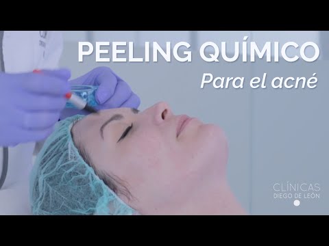 Peeling Químico para Eliminar Marcas de Acné en Clínicas Diego de León