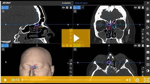 Case study: Frontal sinus anatomy & building blocks software