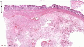 Gastrointestinal Stromal Tumor (GIST) - Histopathology