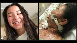 LA teenager’s skin 'melts’ off in severe reaction to prescription medication with strict FDA warning