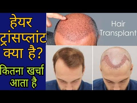 हेयर ट्रांसप्लांट क्या है? खर्चा धारणा है? हेयर ट्रांसप्लांट का पूरा विवरण