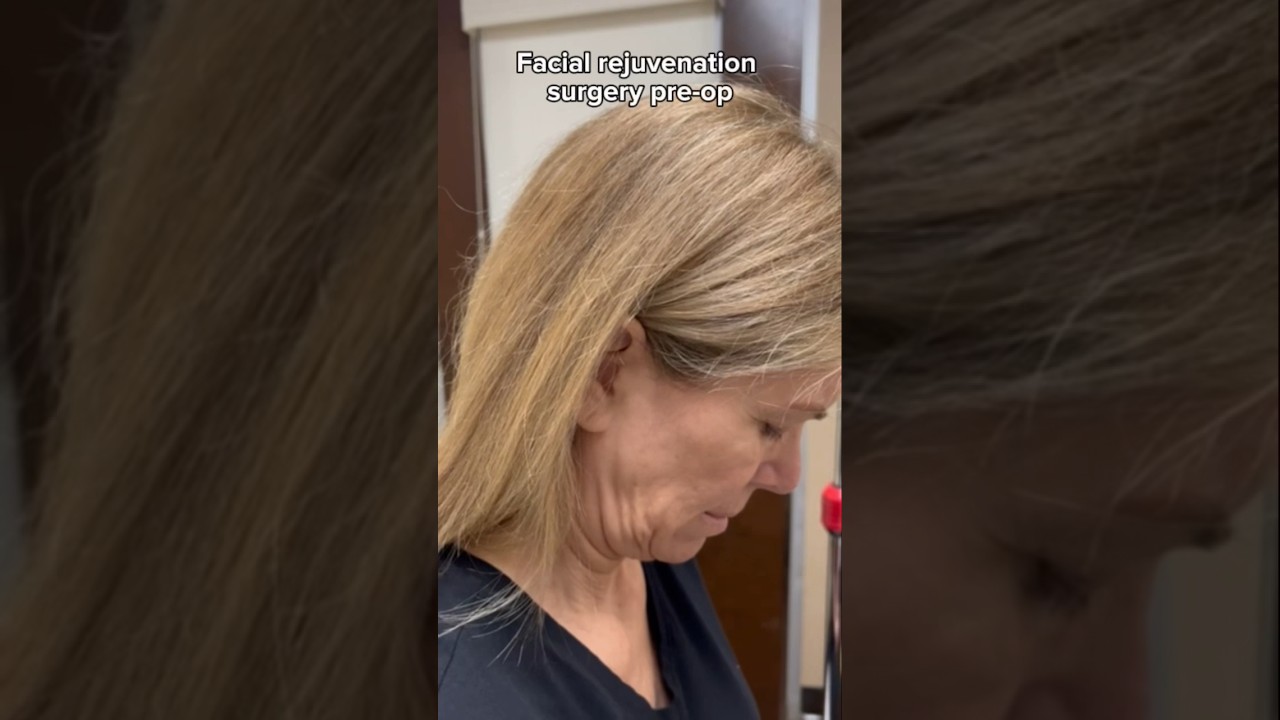 Facial rejuvenation surgery pre-op 