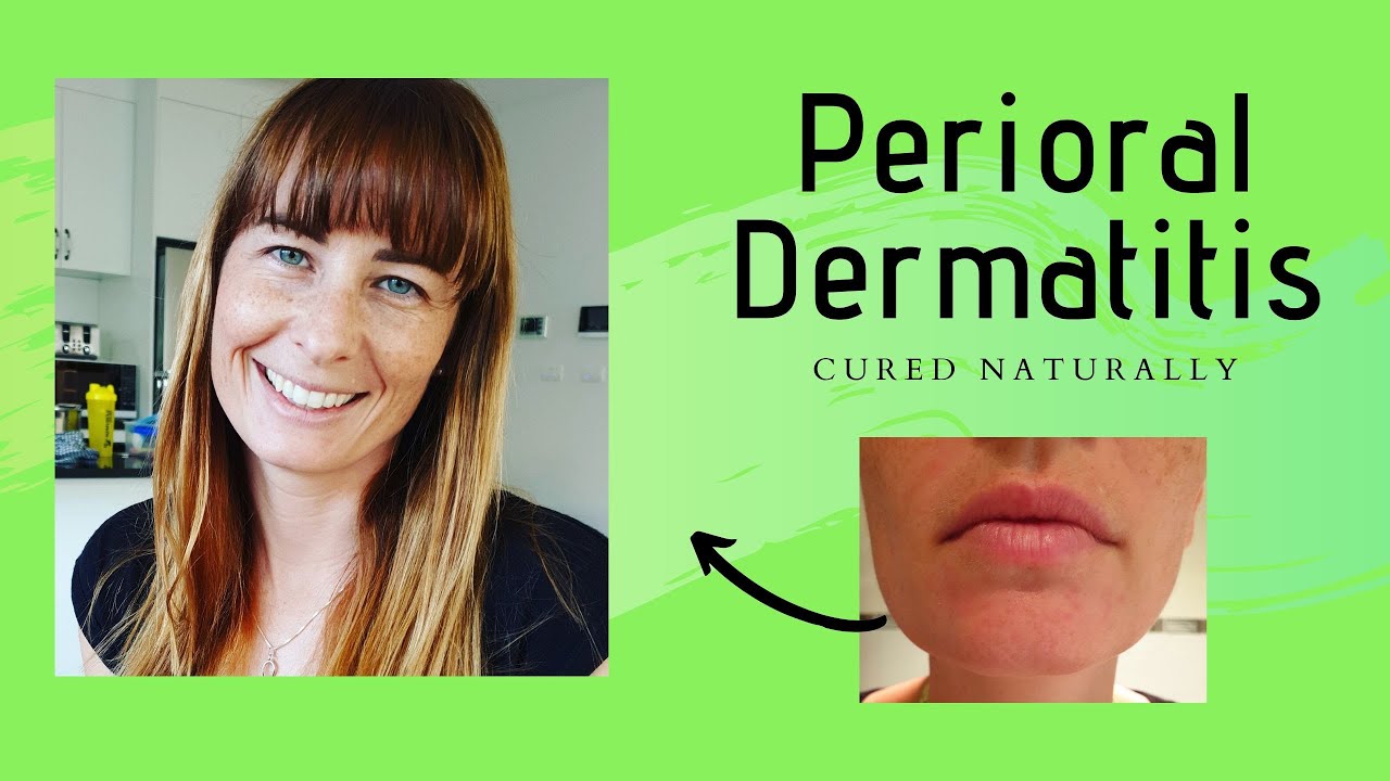 To how treat naturally perioral dermatitis Dealing with