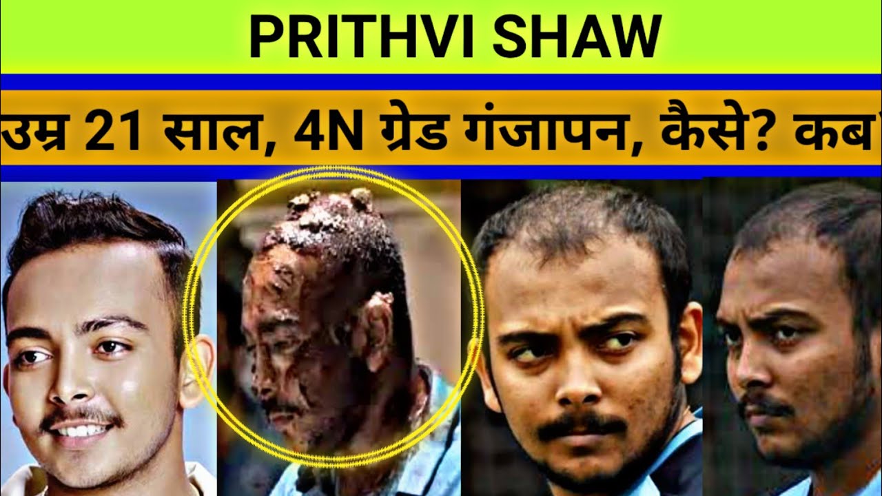 Prithvi Shaw shocking baldness story | उम्र सिर्फ 21 साल और ग्रेड 4 का  गंजापन कैसे हुआ, कब हुआ? - YouTube