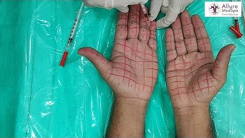 Hyperhidrosis (Excessive sweating) treatment using BOTOX | Dr.Shweta Nangalia