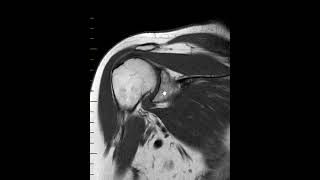 Adhesive capsulitis