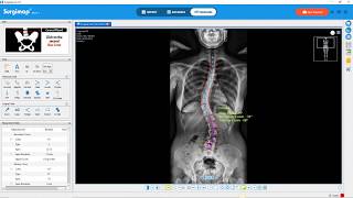 Surgimap Desktop Software - Coronal Alignment Wizard
