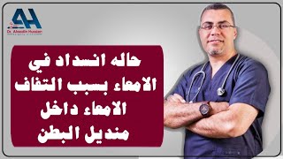 حاله انسداد في الامعاء بسبب التفاف الامعاء داخل منديل البطن