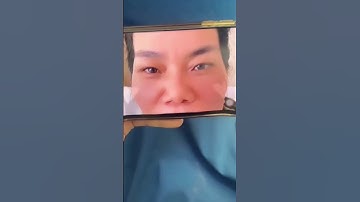 Combo nâng mũi cắt mí cho chị khách Nha Trang🥰 #beauty #pttm #nangmui #catmi #botox #xuhuong