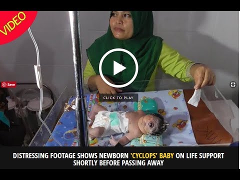 वीडियो: एक आंख वाला उत्परिवर्ती बच्चा लेकिन दो विद्यार्थियों का जन्म फिलीपींस में हुआ था
