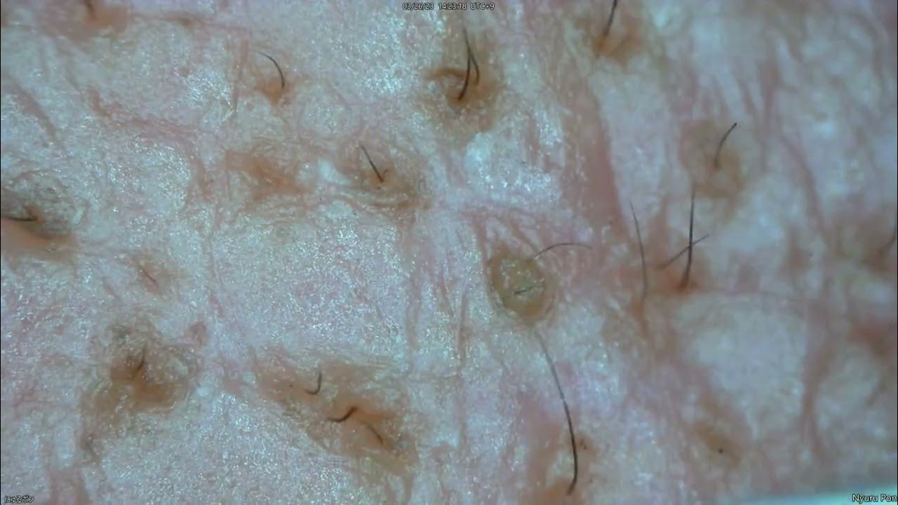 0185 keratin plug removal forehead YouTube