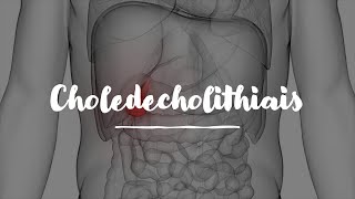 Choledecholithiasis for USMLE Step 1 &amp; USMLE Step 2 Review (3/3)