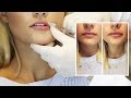 Lip Filler Experience | Start to Finish with 1 Syringe of Juvederm