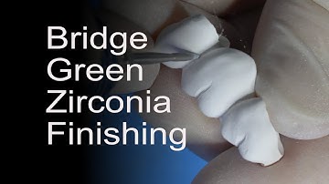 Aesthetic CEREC Zirconia Bridge Workflow