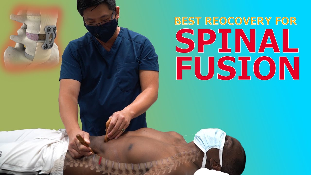 How We Treat A Spinal Fusion | Physical Therapy