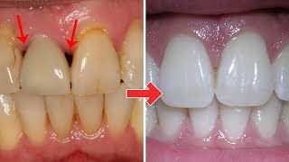 3 Ridiculously easy ways to Treat gum disease at home.