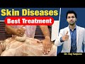 Best treatment for lichen planus pigmentosus hyperpigmentation psoriasis eczema  skin infection