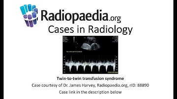 Twin-to-twin transfusion syndrome (Radiopaedia.org) Cases in Radiology