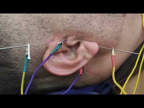 تحفيز العصب السمعي في الطب الصيني