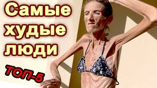 ТОП-5 Самые худые люди в мире.  Живой труп.  Анорексия