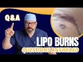 Got Questions About LIPO Burns?  I have the Answers!