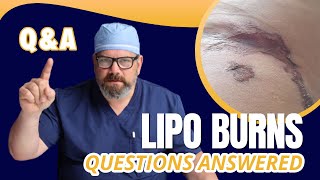 Got Questions About LIPO Burns?  I have the Answers!