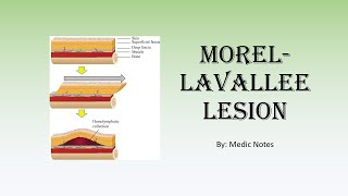 Morel-lavallee lesion - causes, signs and symptoms, investigation, treatment screenshot 5