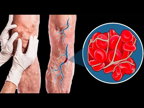 تصویری: 3 راه برای جلوگیری از لخته شدن خون بعد از جراحی