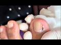 Wow, Super Thick Onychomycosis Requires Careful Trimming! #toenails  #10