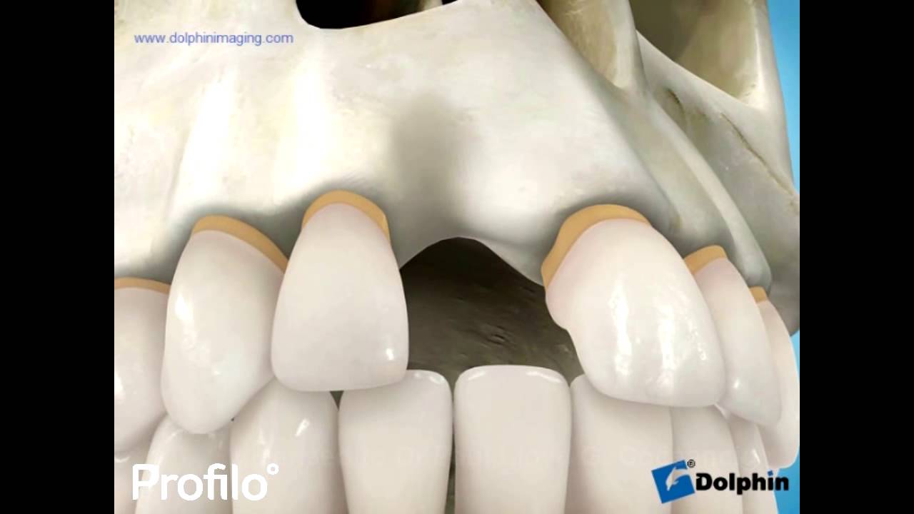 Dental Implants YouTube