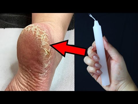The ultimate solution to get rid of cracked feet with a candle in 1 day. ASMR