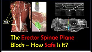 The ESP Block - How Safe Is It?