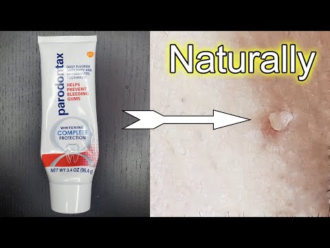 How to Remove Skin Tags Naturally Fast // How To Remove Skin Tag // Skin Tag Removal