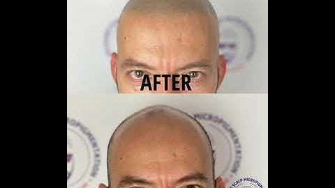 Can Scalp Micropigmentation Work for You?