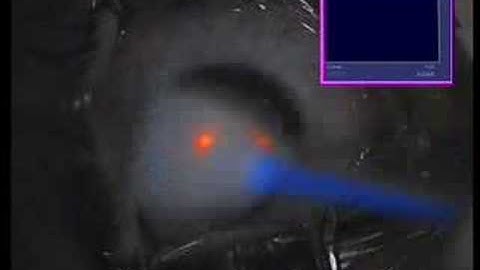 2005: Keratoconus management with the Athens Protocol: The first Topography-guided PRK & CXL