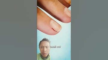 Thumbnail of Why you shouldn't peel your  hangnails 😬