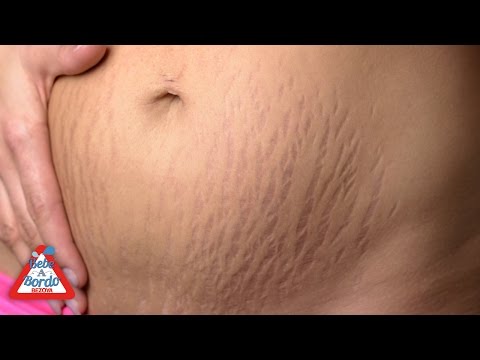 Video: La Modelo Mostraba Celulitis Y Estrías En El Cuerpo Después Del Parto Y Era Conocida Como Una Vaga