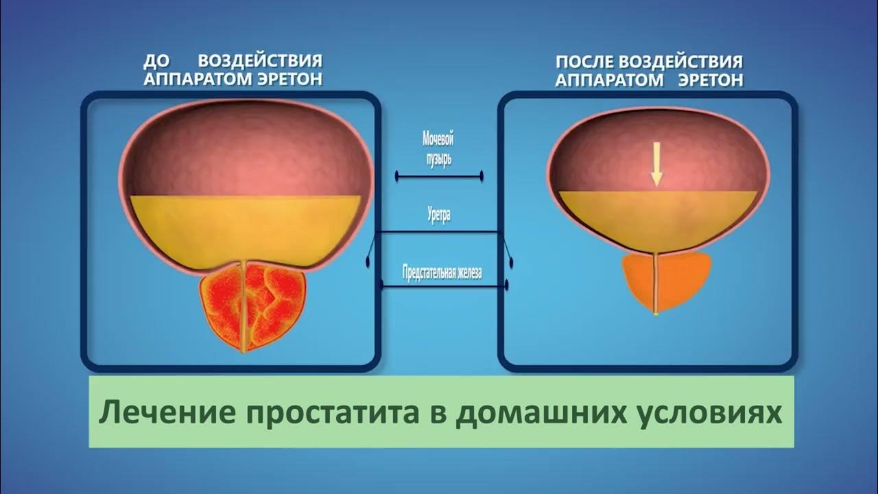 Эретон - урологический аппарат для лечения простатита в домашних ...
