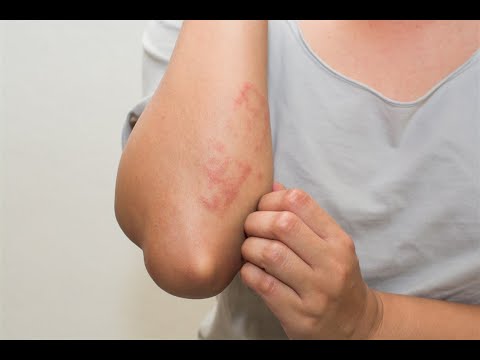تعرف إلى الحكة النفسية وعلاقة التوتر والقلق بها