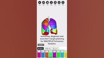 Your pulmonary nodules in 3D. No puncture localization and no entire pulmonary segment resection.