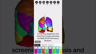 Your pulmonary nodules in 3D. No puncture localization and no entire pulmonary segment resection.