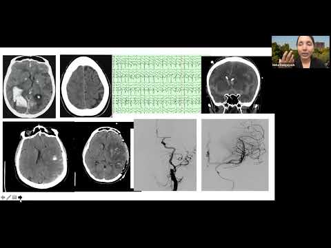 Innovations in Stroke Systems of Care: People, Technology and Compassion